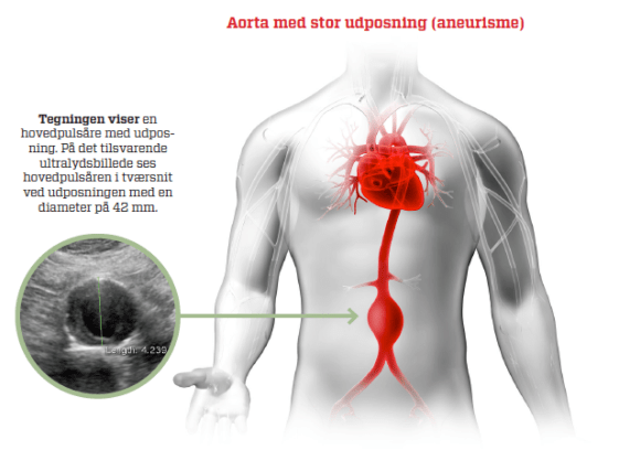 Illustration af udposning på aorta, der fører til aneurisme