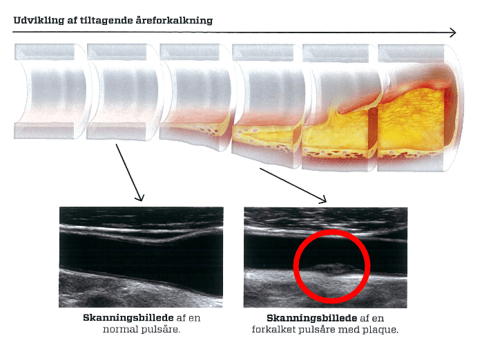 Ultralydsscanning af halspulsåren: Illustration af fire faser af ophobning af kolesterol i arterien.